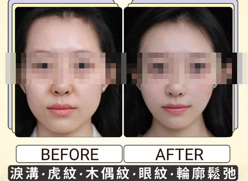 療程進程參考 — 個案一
