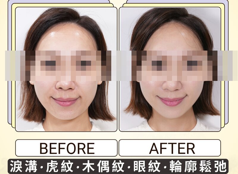 療程進程參考 — 個案二